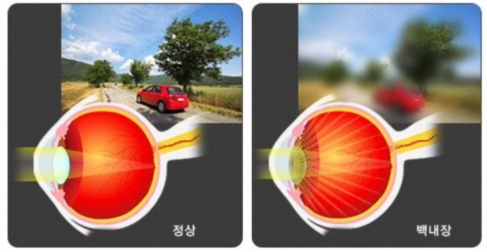 당뇨병 환자, 백내장 걸릴확률 2배...45~54세는 4~6배 높다 당뇨병 환자, 백내장 걸릴확률 2배...45~54세는 4~6배 높다