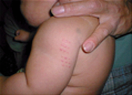 경피용 백신을 맞은 아기의 모습. (사진제공=식품의약품안전처)