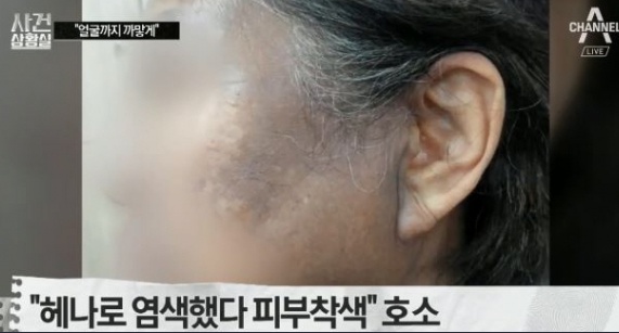 헤나 염모제에 의한 피부부작용 사례(사진 A채널에서 캡처)