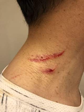 지난해 8월 10일 김경수 경남지사는 목부위에 상처를 입는 폭행을 당했다. (사진출처= 더불어민주당 기동민 의원 페이스북 캡처)