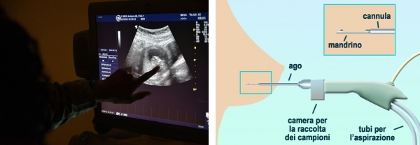 왼쪽은 한 의사가 유방 초음파 검사를 진행하고 있는 사진, 오른쪽은 맘모톰 시술 원리를 보여주는 설명도. (자료=위키피디아)