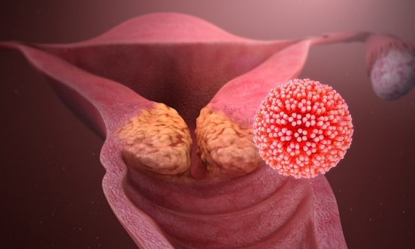 자궁경부암과 암을 일으킨 HPV 이미지(출처: Wikimedia)