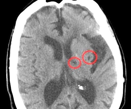 뇌의 미세뇌출혈 영상(사진: wikimedia.org)