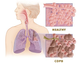 건강한 사람과 COPD환자의 폐(폐포) 비교.