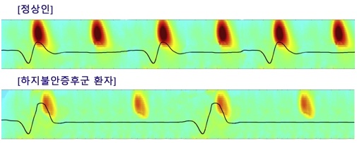 위쪽 붉은색이 수면방추, 아래쪽 선이 느린진동이다. 그림처럼 환자는 수방추의 활성화도 옅고,느린진동의 최고점에서 만나는 연결성도 떨어진다.(서울대병원 자료)