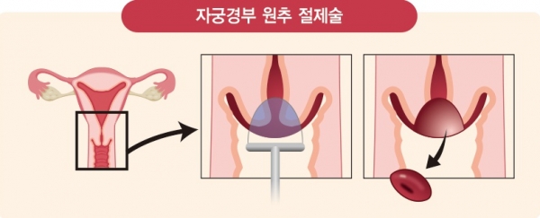 자궁경부 원추절제술 그림(자료=강동경희대병원)