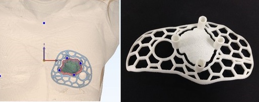 유방암 3D프린팅 수술가이드 실제 모형.