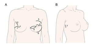 기존 유방암 수술(A)과 로봇을 이용한 절제술(B)의 절개부위 비교.